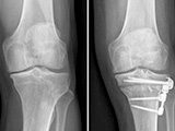 Osteotomia do joelho